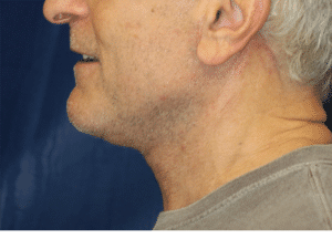 Natural Neck Lift