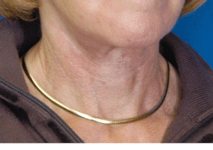 Natural Neck Lift