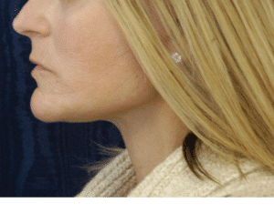 Natural Neck Lift