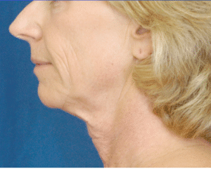 Natural Neck Lift