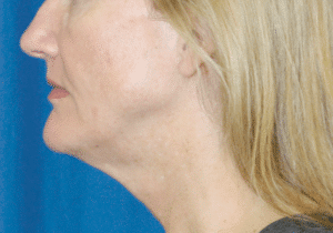 Natural Neck Lift