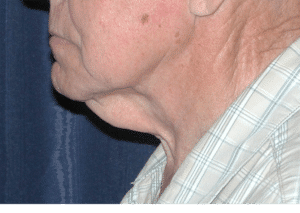 Natural Neck Lift