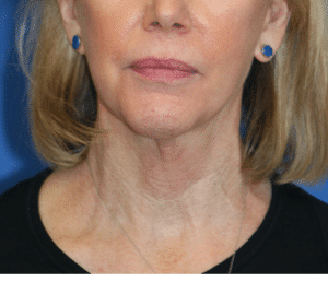 Natural Neck Lift