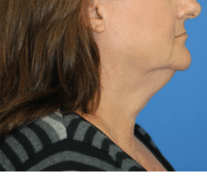 Natural Neck Lift