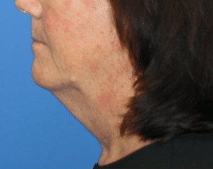 Natural Neck Lift