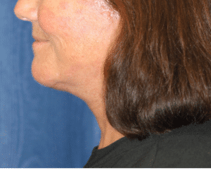 Natural Neck Lift
