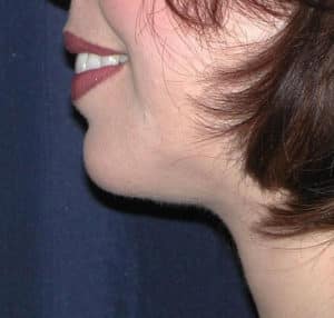 Submental Liposuction