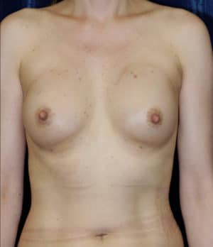 Fat Grafting to Breast