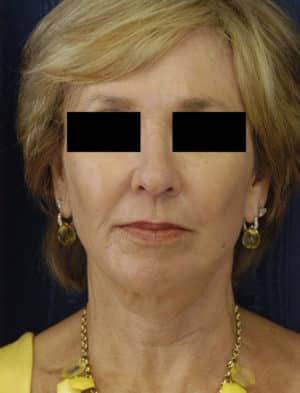 Facelift