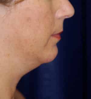 Submental Liposuction