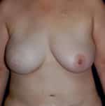Breast Reconstruction
