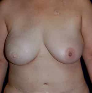 Breast Reconstruction