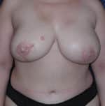 Breast Reconstruction