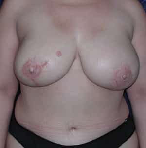 Breast Reconstruction