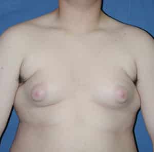 Gynecomastia