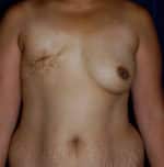 Breast Reconstruction