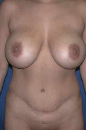 Abdominoplasty