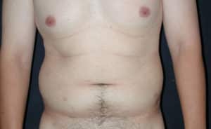 Liposuction