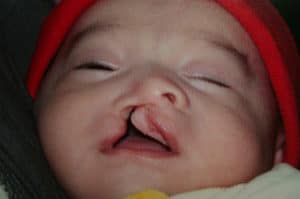Cleft Palate / Cleft Lip