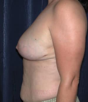 Breast Reduction
