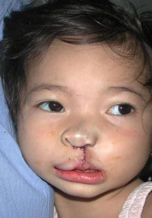 Cleft Palate / Cleft Lip