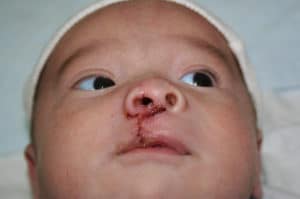 Cleft Palate / Cleft Lip
