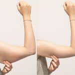 How to Prepare for Brachioplasty Surgery